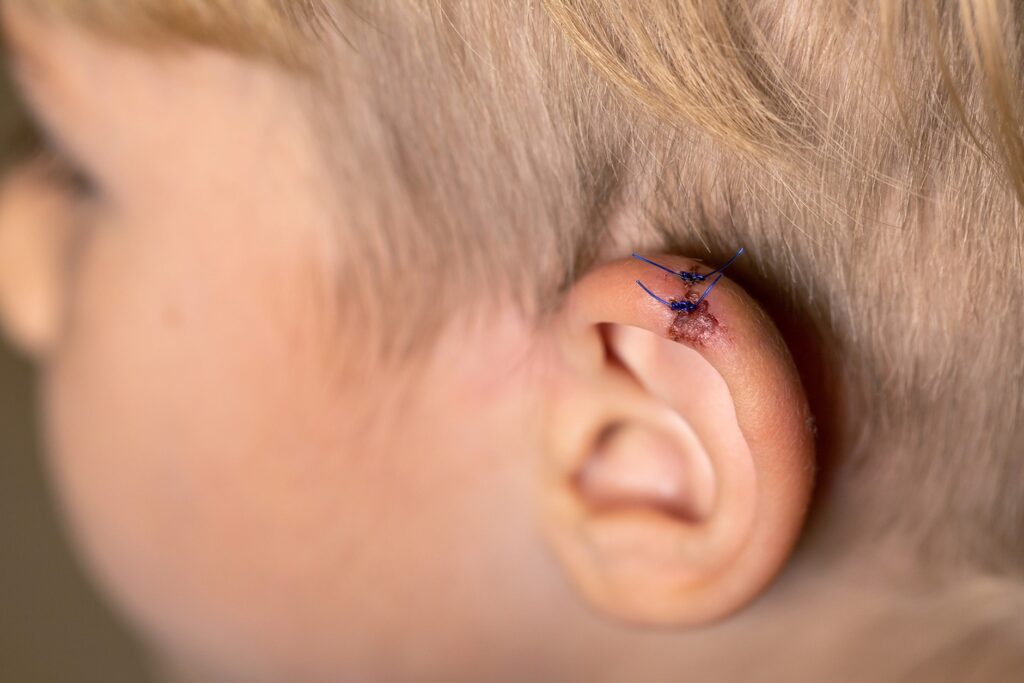 Does my child need stitches?