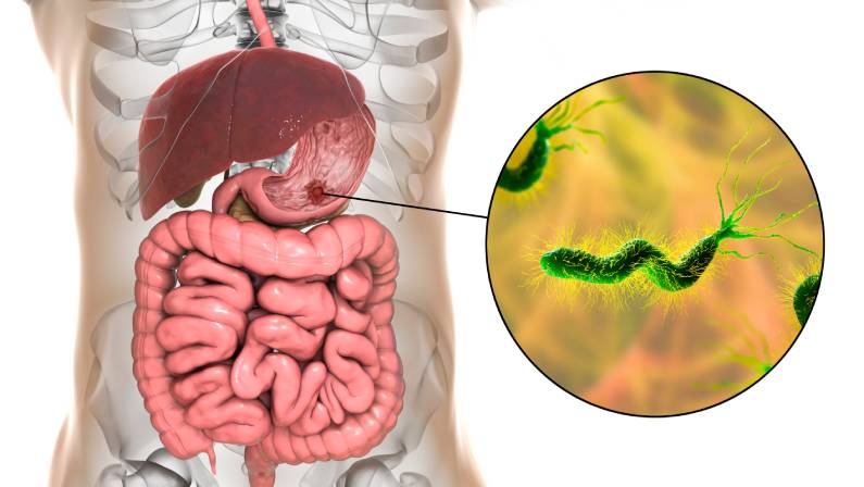 Stomach ulcer and closeup view of bacteria Helicobacter pylori, associated with ulcer formation, 3D illustration