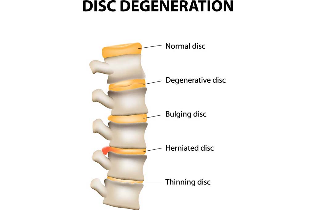 Disk degeneration