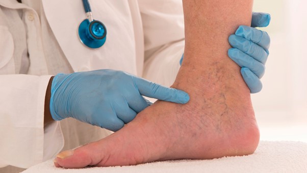 What is Edema and how to treat it