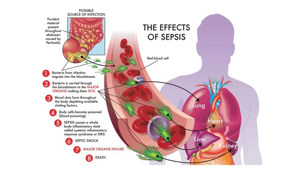 Septic Shock